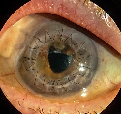 Penetrating corneal transplant with Trab