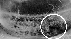 Angiography showing gland loss